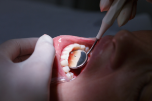 receding-gums-dentist-albany-park