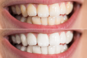 Before and after professional teeth whitening