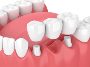 Dental crowns