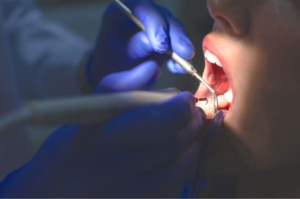 Professional teeth cleaning procedure by a Forest Glen dentist