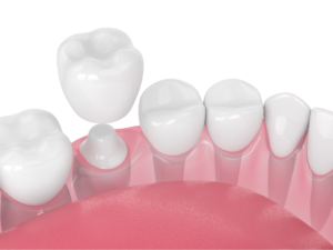 Dental crowns in Norwood Park, Chicago