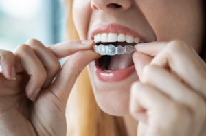 Clear teeth aligners at a dental office in Lincolnwood, Illinois