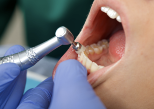 Professional teeth cleaning at a dental office in Harwood Heights, Illinois