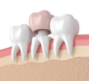 Dental crowns by a dentist in Albany Park, Chicago