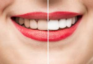 Professional teeth whitening results by a dentist in Sauganash, Chicago