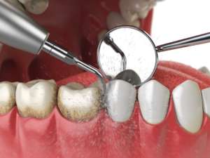 Teeth cleaning by a dentist in Forest Glen, Chicago