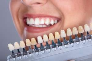 Teeth whitening at a dental office in Lincolnwood, Illinois