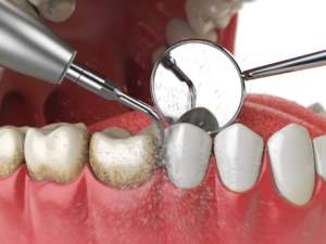 Professional teeth cleaning by a dentist in Union Ridge, Chicago