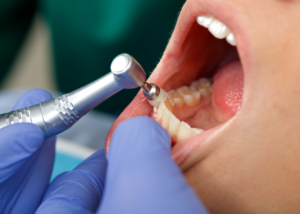 Professional teeth cleaning with a dentist in Old Irving Park, Chicago