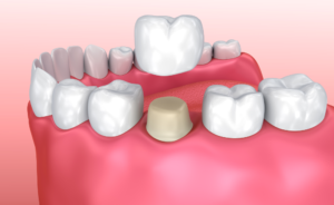 Dental crowns by a dentist in Union Ridge, Chicago