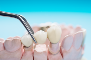 Dental crowns by a dentist in Albany Park Chicago